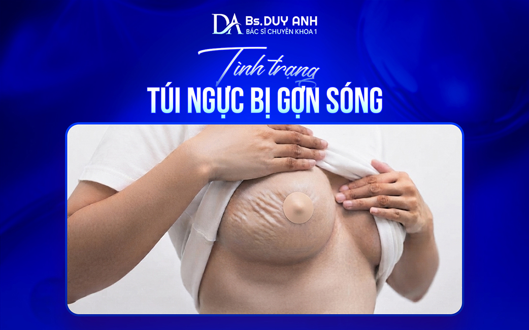 Biểu hiện của túi ngực bị gợn sóng