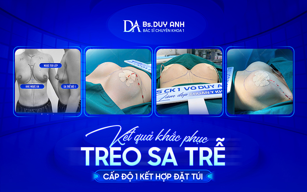 Ca thực tế treo sa trễ cấp độ 1 kết hợp đặt túi ngực