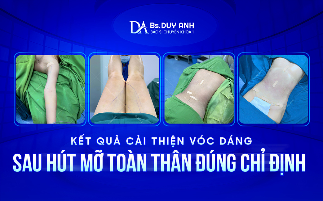 Kết quả thực tế sau hút mỡ toàn thân