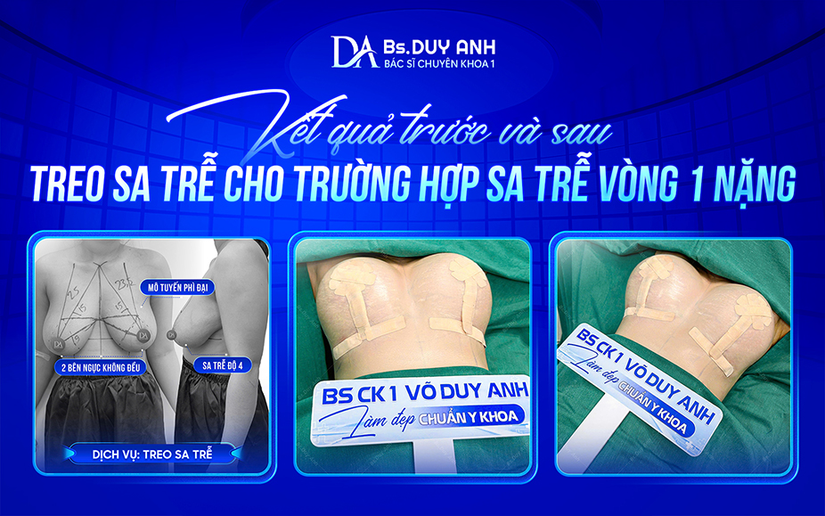 Kết quả cải thiện vòng 1 sau treo sa trễ ở trường hợp chảy xệ nặng