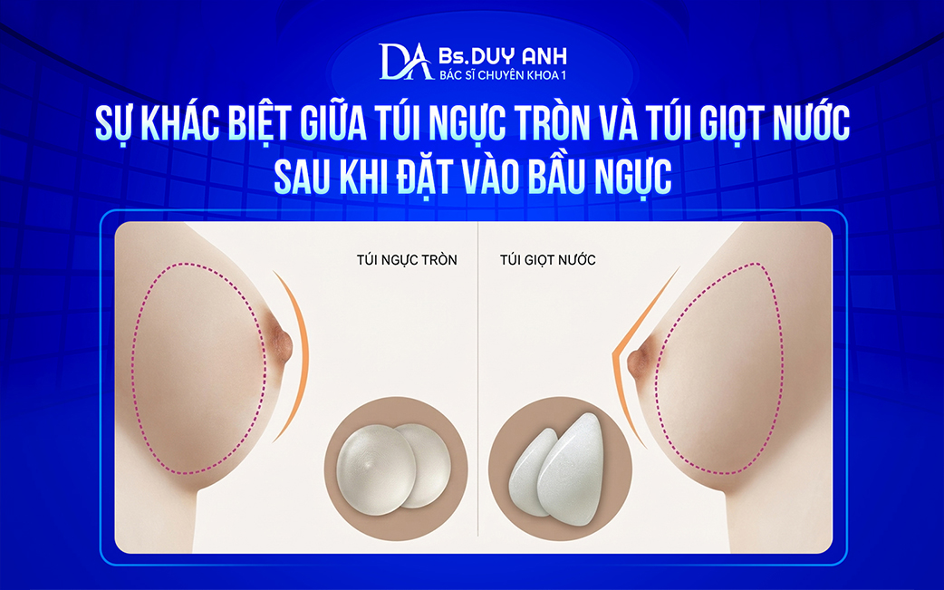 Khác biệt về dáng ngực giữa túi ngực tròn và túi ngực giọt nước