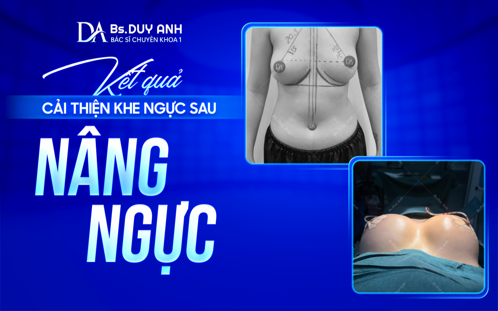Khe ngực được cải thiện sau khi lựa chọn đúng kỹ thuật nâng ngực
