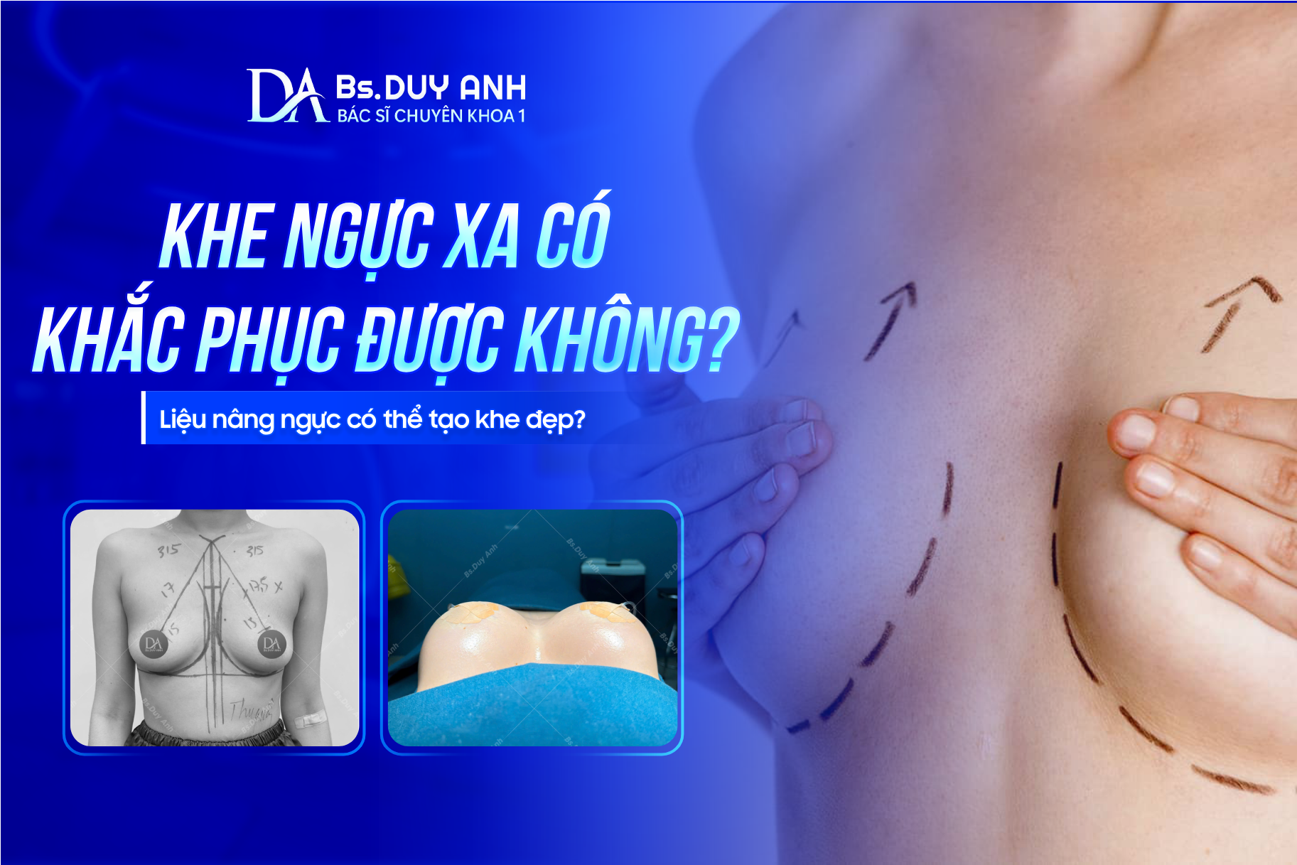 Khe Ngực Xa Có Khắc Phục Được Không? Liệu Nâng Ngực Có Thể Tạo Khe Đẹp?