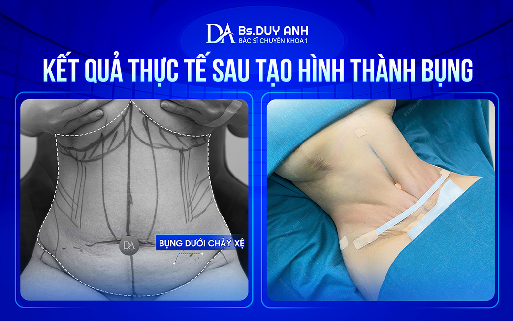 Sự thay đổi sau tạo hình thành bụng