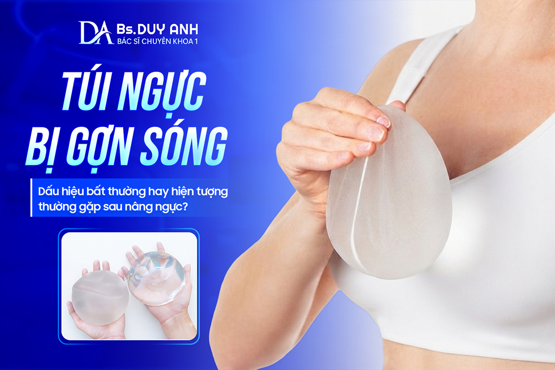 Túi Ngực Bị Gợn Sóng: Dấu Hiệu Bất Thường Hay Hiện Tượng Thường Gặp Sau Nâng Ngực?
