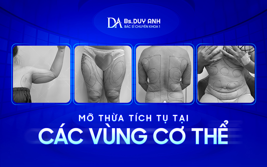 Vị trí mỡ thừa thường xuất hiện trên cơ thể