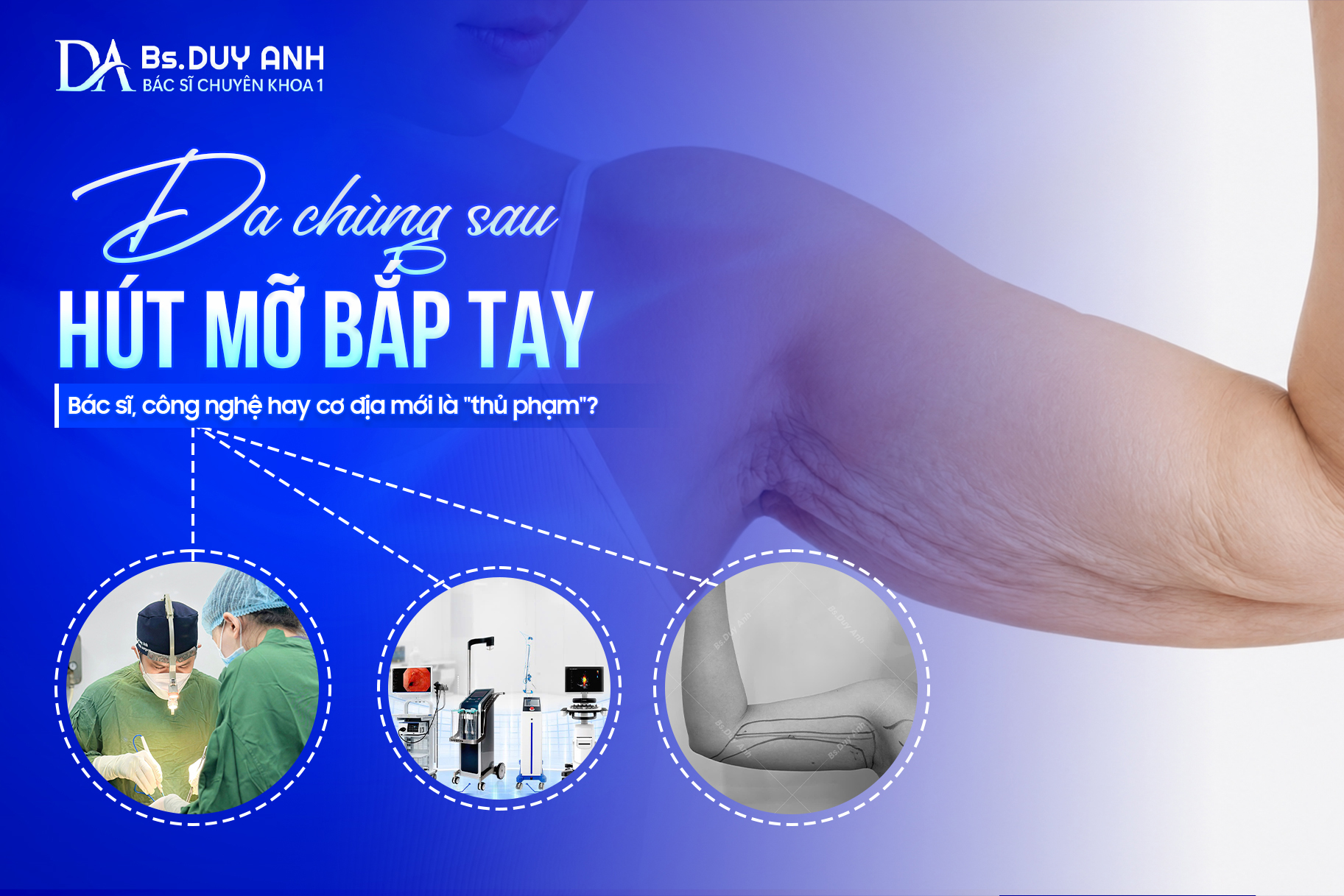 Da Chùng Sau Hút Mỡ Bắp Tay: Bác Sĩ, Công Nghệ Hay Cơ Địa Mới Là “Thủ Phạm”?