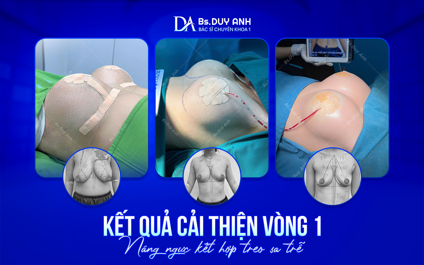 Hình ảnh thực tế trước và sau phẫu thuật nâng ngực kết hợp treo sa trễ
