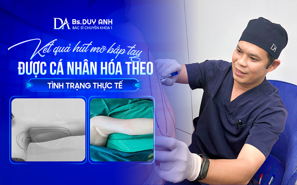 Hút mỡ bắp tay theo đúng chỉ định và tình trạng của từng khách hàng