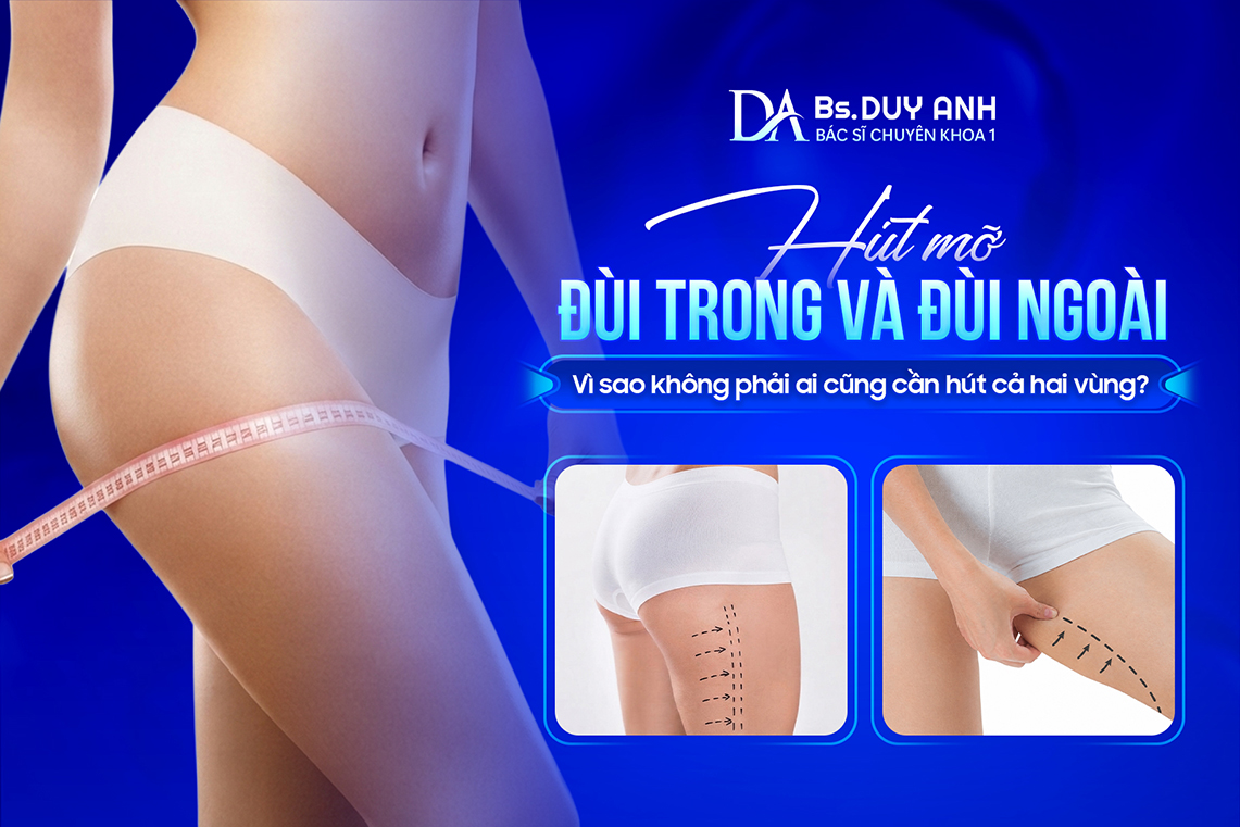 Hút Mỡ Đùi Trong Và Đùi Ngoài: Vì Sao Không Phải Ai Cũng Cần Hút Cả Hai Vùng?