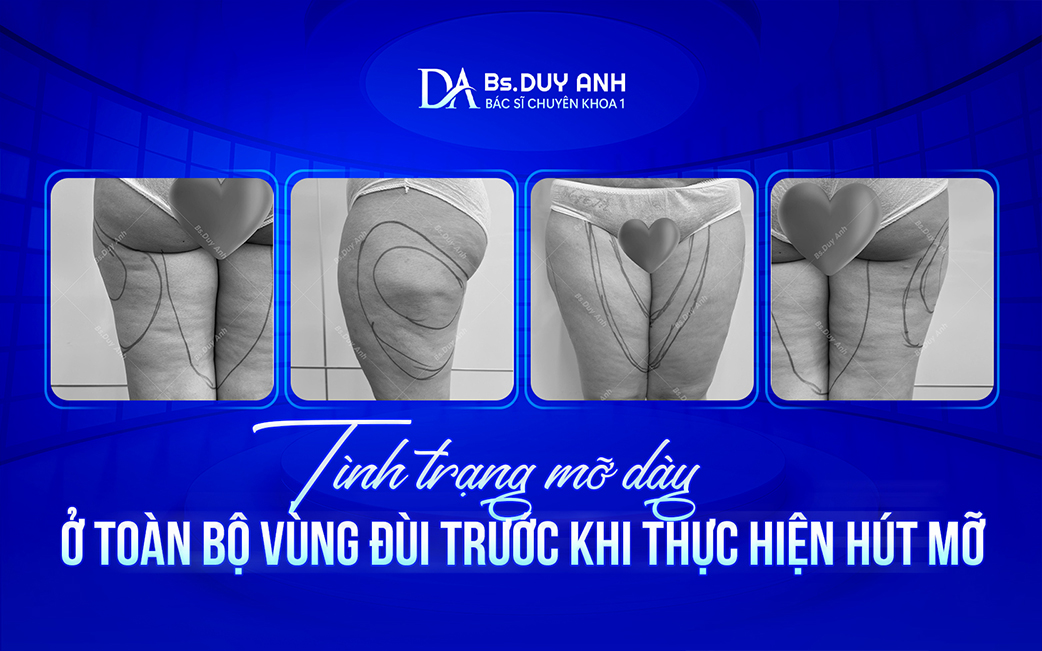 Mỡ thừa phân bố rộng khắp vùng đùi trước hút mỡ