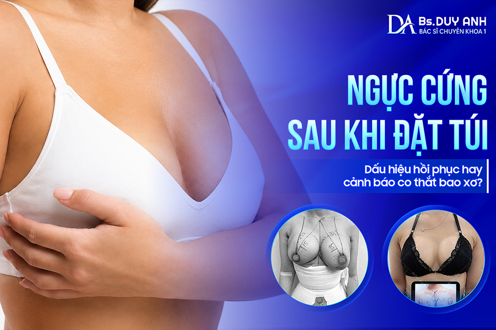 Ngực Cứng Sau Khi Đặt Túi: Dấu Hiệu Hồi Phục Hay Cảnh Báo Co Thắt Bao Xơ?