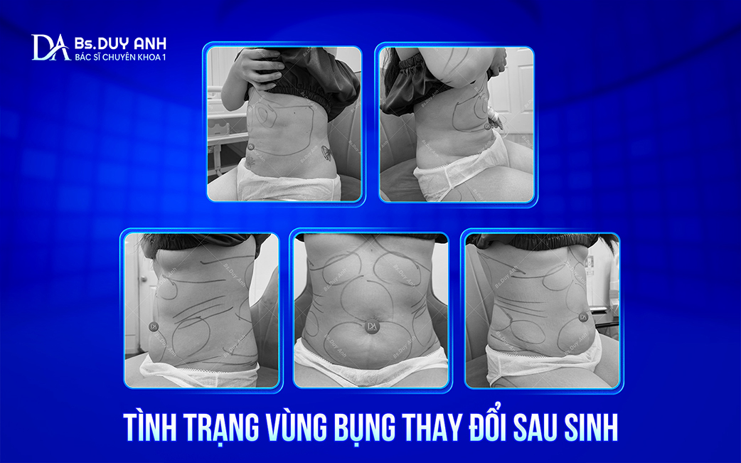 Những thay đổi về mỡ và da của vùng bụng sau sinh
