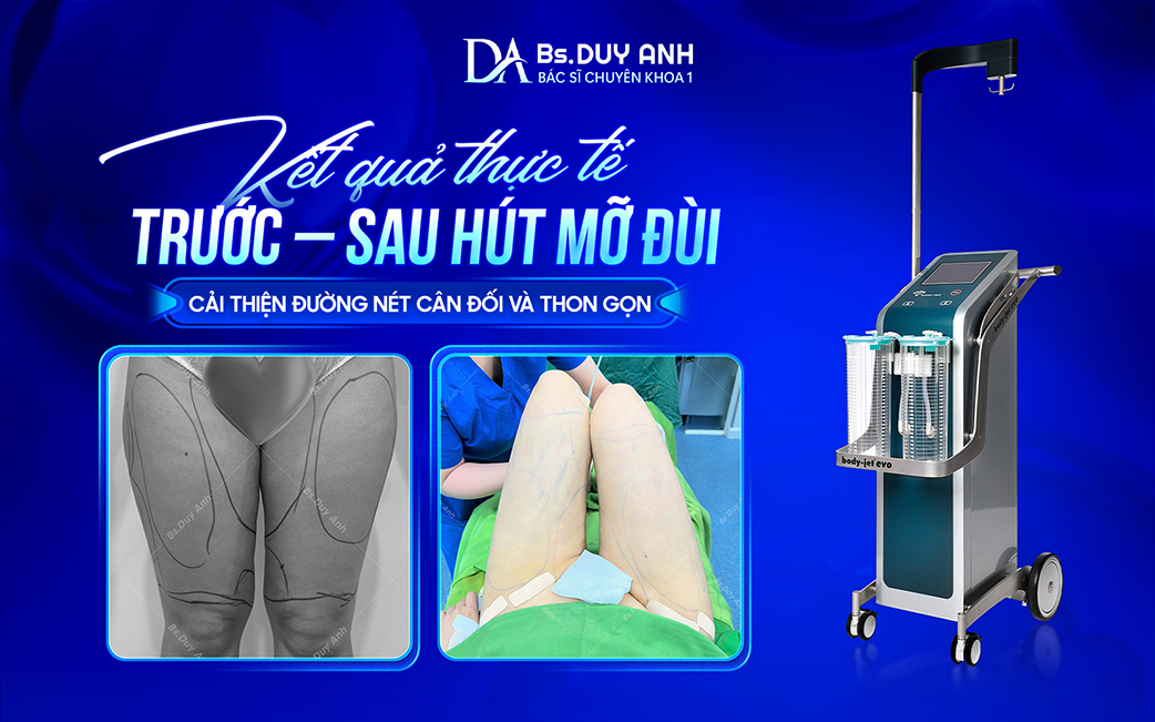Trước và sau hút mỡ đùi, đường cong cơ thể trở nên hài hòa hơn