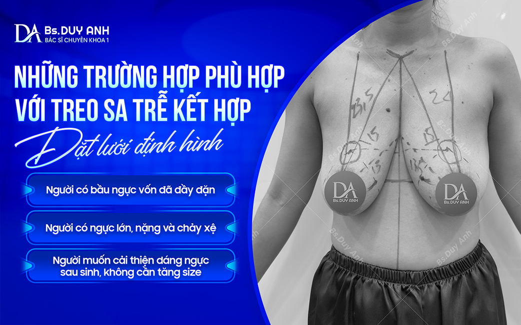 Các trường hợp có thể cân nhắc treo sa trễ kết hợp đặt lưới định hình