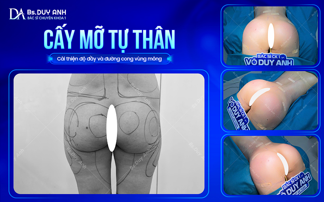 Cấy mỡ tự thân tạo đường cong vùng mông hài hòa, tự nhiên