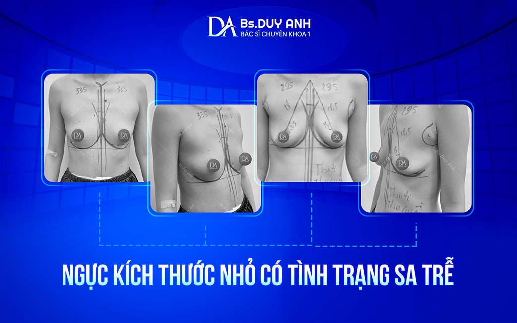 Dáng ngực nhỏ đi kèm tình trạng sa trễ