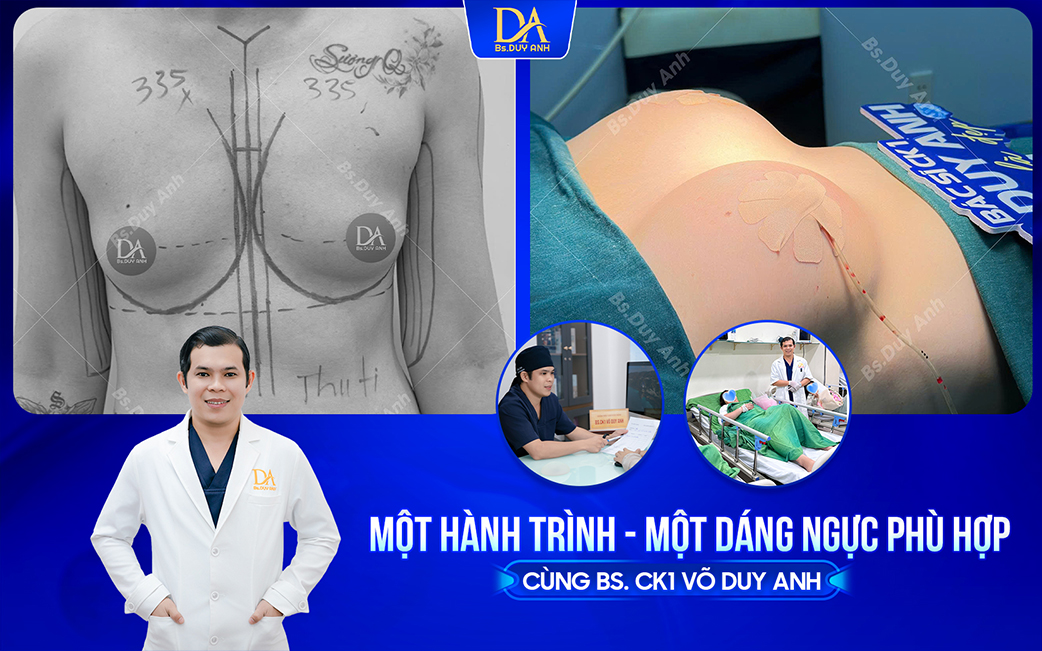 Hiểu dáng ngực, chọn hướng phù hợp cùng BS. CK1 Võ Duy Anh