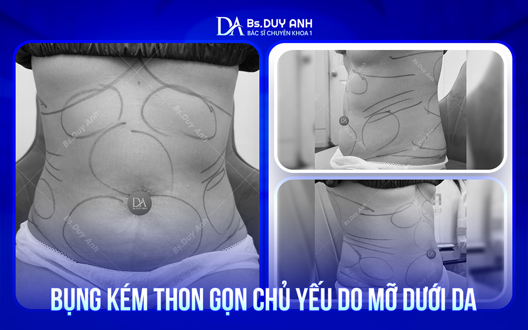 Mỡ dưới da tích tụ khiến vùng bụng trở nên kém săn gọn