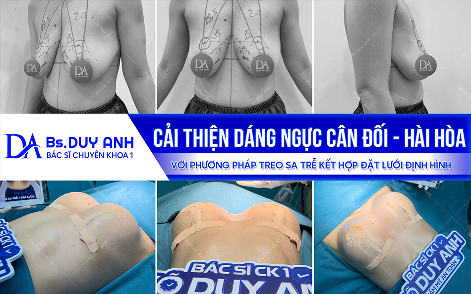 Nâng chỉnh và định hình vòng một cân đối với phương pháp treo sa trễ kết hợp đặt lưới định hình