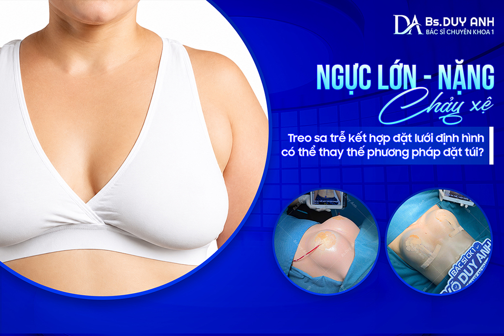 Ngực Lớn, Nặng, Chảy Xệ: Treo Sa Trễ Kết Hợp Đặt Lưới Định Hình Có Thể Thay Thế Phương Pháp Đặt Túi?