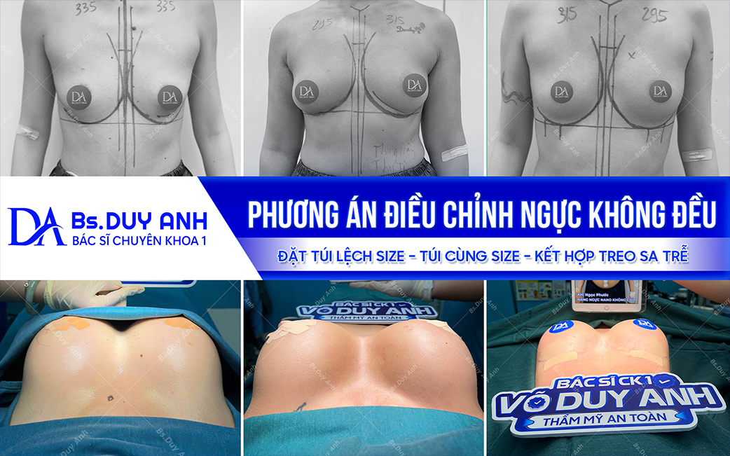 Các phương án cải thiện dáng ngực không cân đối theo từng tình trạng