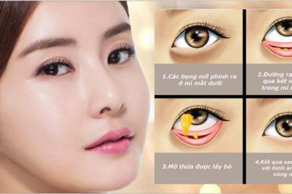 Bóc mỡ mắt