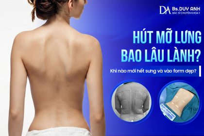Hút Mỡ Lưng Bao Lâu Lành? Khi Nào Mới Hết Sưng Và Vào Form Đẹp?
