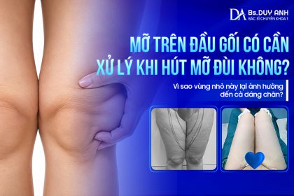 Mỡ Trên Đầu Gối Có Cần Xử Lý Khi Hút Mỡ Đùi Không? Vì Sao Vùng Nhỏ Này Lại Ảnh Hưởng Đến Cả Dáng Chân?