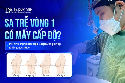 Sa Trễ Vòng 1 Có Mấy Cấp Độ? Mỗi Tình Trạng Phù Hợp Với Phương Pháp Khắc Phục Nào?