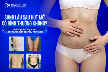 Sưng Lâu Sau Hút Mỡ Có Bình Thường Không? Giải Đáp Chuẩn Y Khoa & Cách Nhận Biết Dấu Hiệu Nguy Hiểm